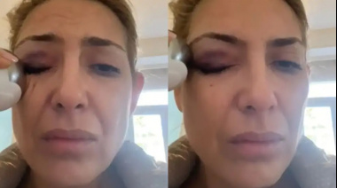 Aparecieron nuevas imágenes de Fabiola Yañez con golpes que se suman a la causa por violencia de género contra Alberto Fernández