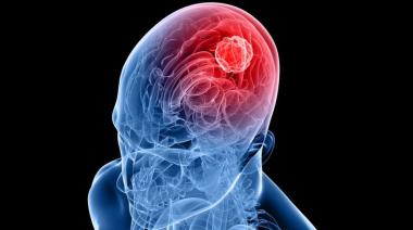 Logran frenar un agresivo cáncer cerebral con una nueva estrategia terapéutica