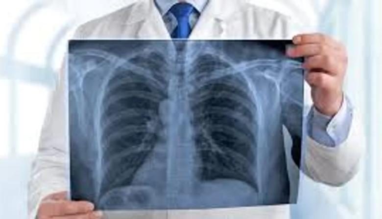 Día del Cáncer de Pulmón: prevén el aumento del 80% de casos en Argentina para 2050