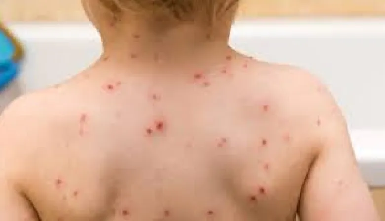 Confirmaron un caso de sarampión en Entre Ríos y emiten alerta epidemiológica