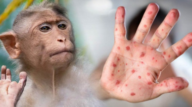 Viruela del mono en la provincia de Buenos Aires: refuerzan controles de prevención y detección