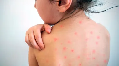 Incremento de casos de sarampión en el AMBA: autoridades intensifican campaña de vacunación