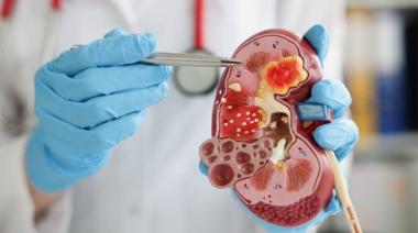 Cáncer renal: 5.000 casos por año y baja detección temprana