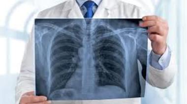Día del Cáncer de Pulmón: prevén el aumento del 80% de casos en Argentina para 2050