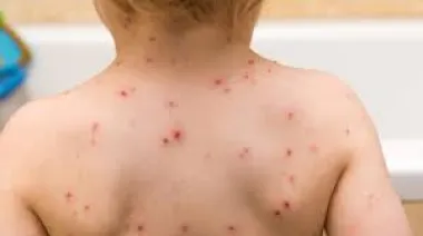 Confirmaron un caso de sarampión en Entre Ríos y emiten alerta epidemiológica