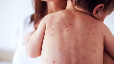 Dengue y chikungunya en Cuba: el dato sobre hospitales que preocupa a la región