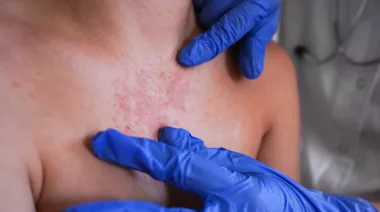 Repunte de sarampión en América: por qué Costa Rica encendió la alerta