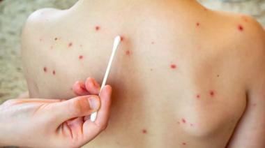 Brote de sarampión: confirman nuevo caso importado y lanzan alerta epidemiológica