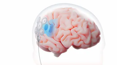Israel estrena EASEE, un implante que combate la epilepsia sin abrir el cráneo