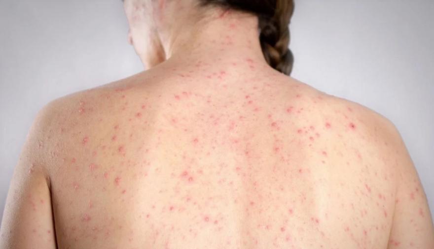 Alerta en Argentina: cuatro casos de sarampión preocupan a las autoridades