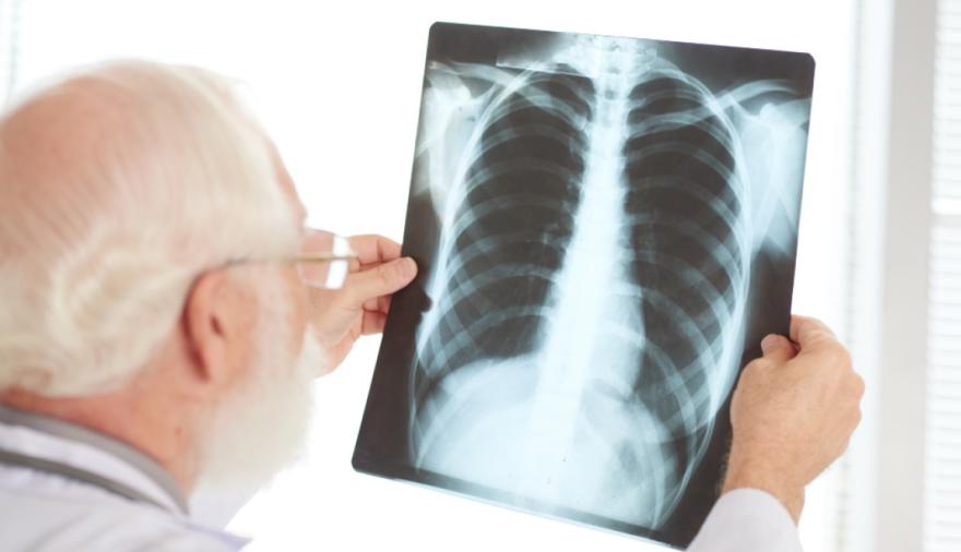 Ministerio de Salud actualizó el manual de tuberculosis tras 11 años sin cambios