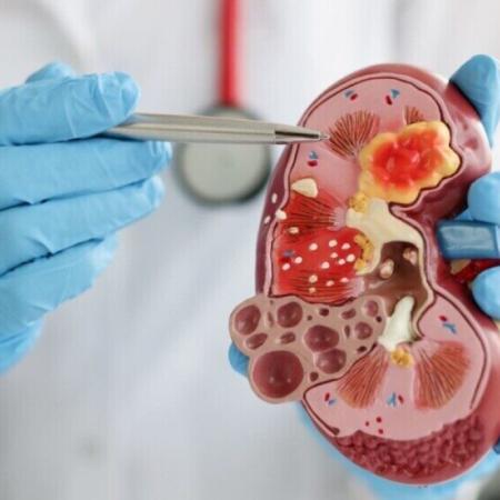 Cáncer renal: 5.000 casos por año y baja detección temprana