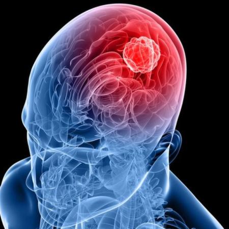Logran frenar un agresivo cáncer cerebral con una nueva estrategia terapéutica