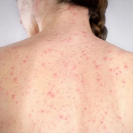 Alerta en Argentina: cuatro casos de sarampión preocupan a las autoridades