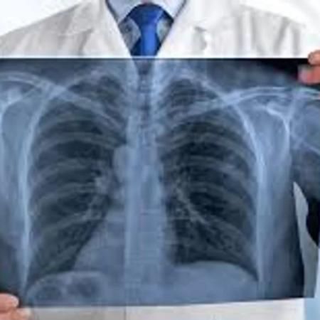 Día del Cáncer de Pulmón: prevén el aumento del 80% de casos en Argentina para 2050