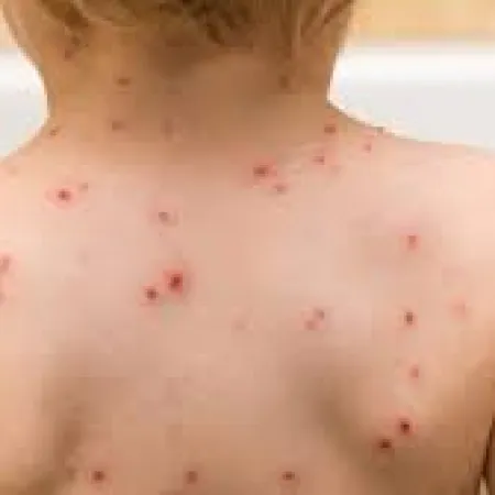 Confirmaron un caso de sarampión en Entre Ríos y emiten alerta epidemiológica