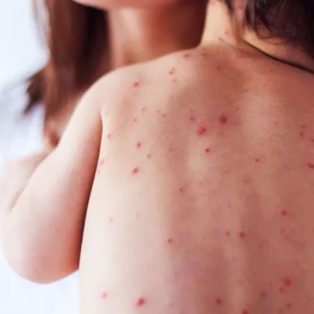 Dengue y chikungunya en Cuba: el dato sobre hospitales que preocupa a la región