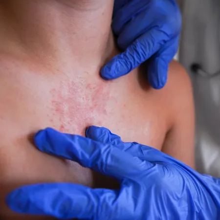 Repunte de sarampión en América: por qué Costa Rica encendió la alerta