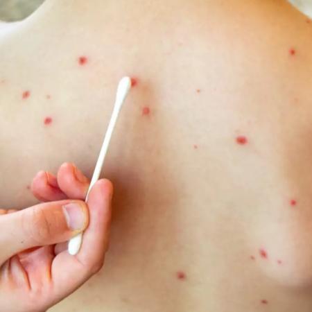 Brote de sarampión: confirman nuevo caso importado y lanzan alerta epidemiológica