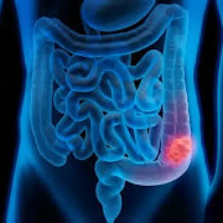 Día Mundial contra el Cáncer de Colon: qué recomienda el sistema de salud