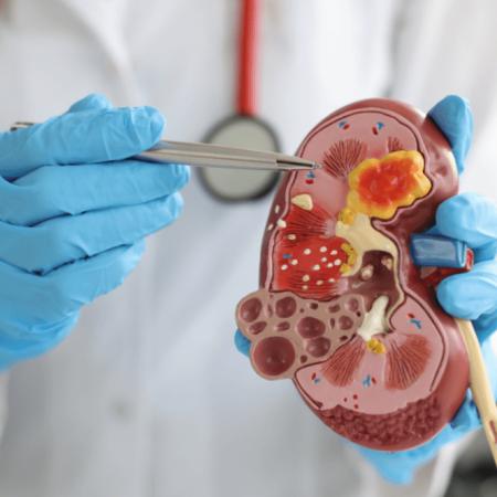Refuerzan la atención para pacientes con enfermedad renal crónica en el país