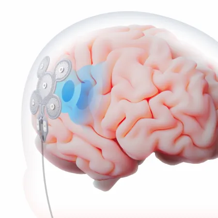 Israel estrena EASEE, un implante que combate la epilepsia sin abrir el cráneo
